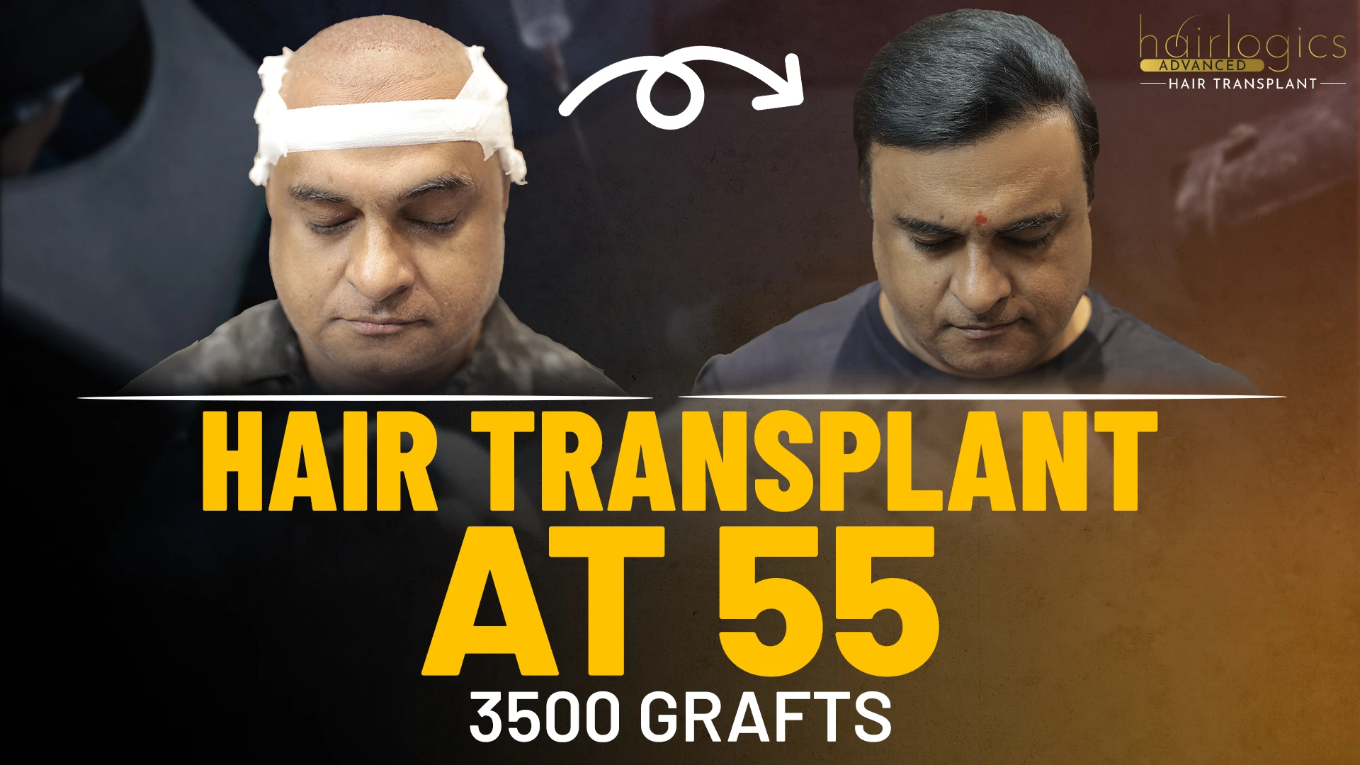 hair transplant before and after