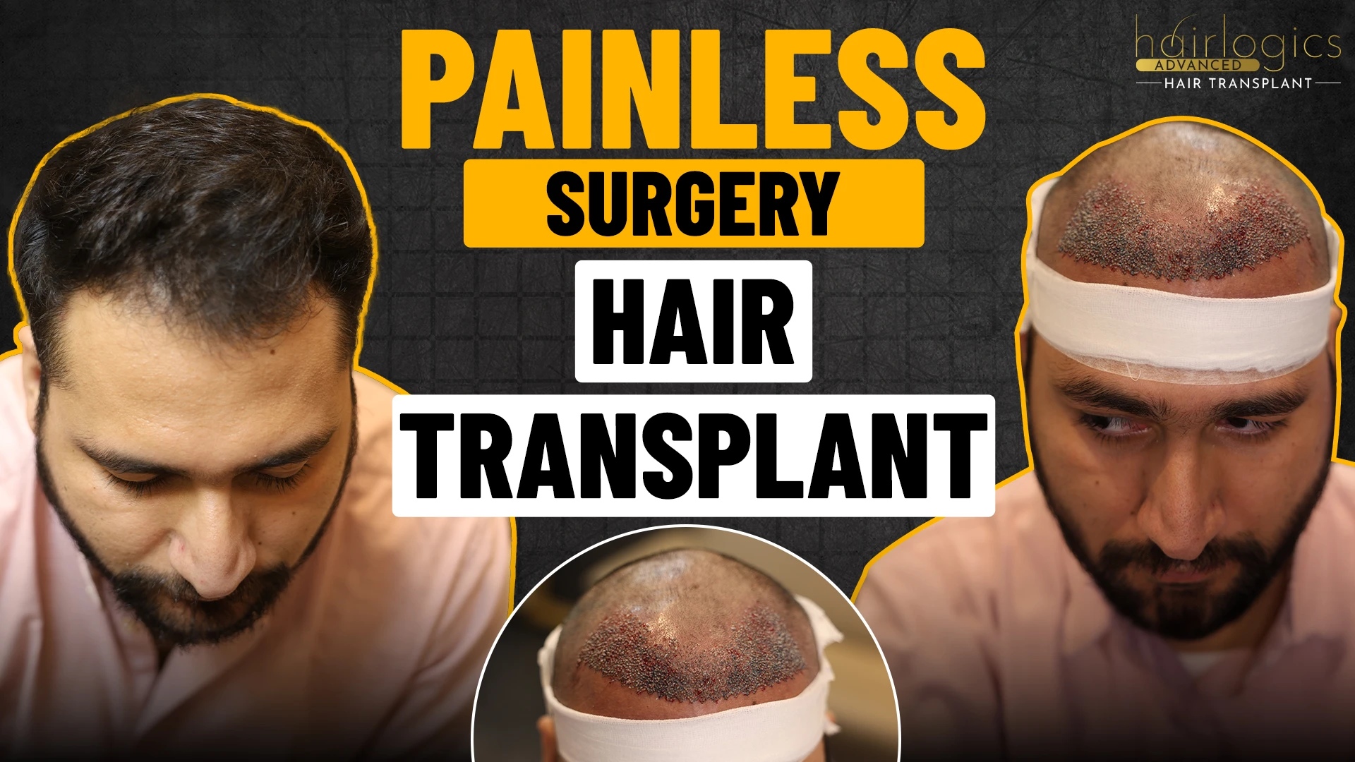 hair transplant before and after
